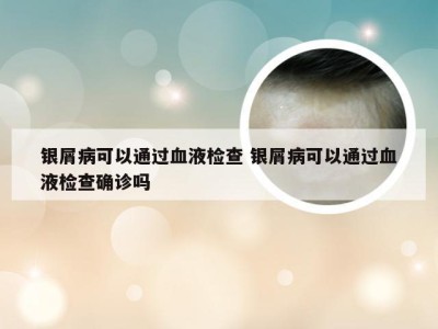 银屑病可以通过血液检查 银屑病可以通过血液检查确诊吗
