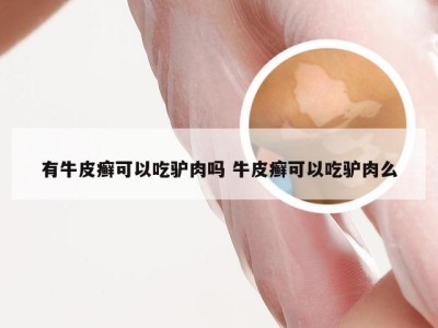 有牛皮癣可以吃驴肉吗 牛皮癣可以吃驴肉么