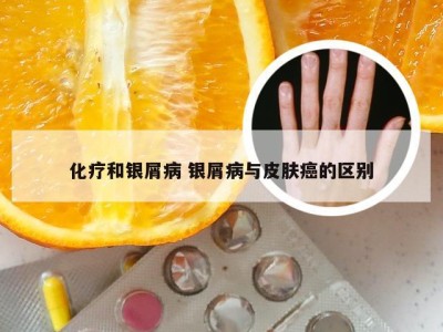 化疗和银屑病 银屑病与皮肤癌的区别