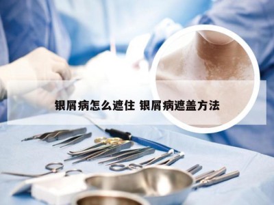 银屑病怎么遮住 银屑病遮盖方法
