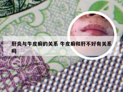 肝炎与牛皮癣的关系 牛皮癣和肝不好有关系吗