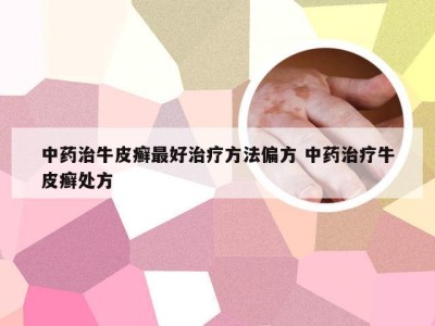 中药治牛皮癣最好治疗方法偏方 中药治疗牛皮癣处方