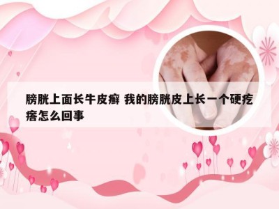 膀胱上面长牛皮癣 我的膀胱皮上长一个硬疙瘩怎么回事