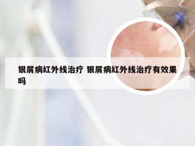 银屑病红外线治疗 银屑病红外线治疗有效果吗
