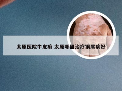 太原医院牛皮癣 太原哪里治疗银屑病好