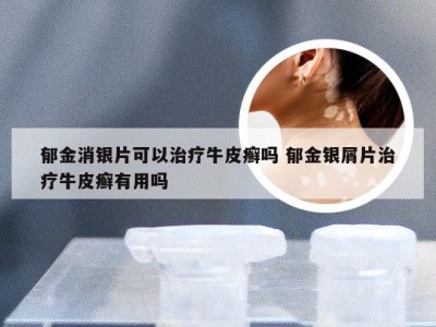郁金消银片可以治疗牛皮癣吗 郁金银屑片治疗牛皮癣有用吗