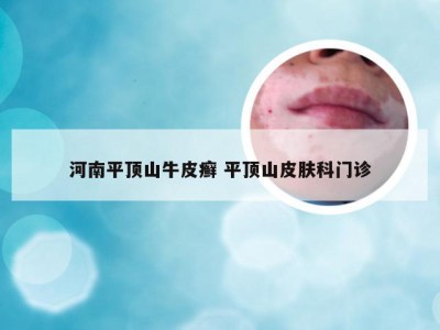 河南平顶山牛皮癣 平顶山皮肤科门诊