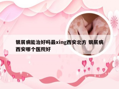 银屑病能治好吗最xing西安北方 银屑病西安哪个医院好