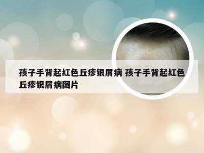 孩子手背起红色丘疹银屑病 孩子手背起红色丘疹银屑病图片