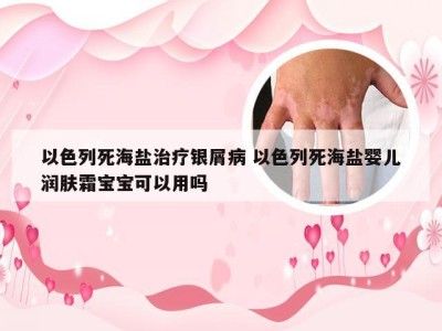 以色列死海盐治疗银屑病 以色列死海盐婴儿润肤霜宝宝可以用吗