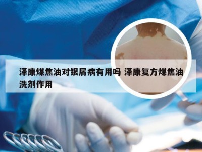 泽康煤焦油对银屑病有用吗 泽康复方煤焦油洗剂作用