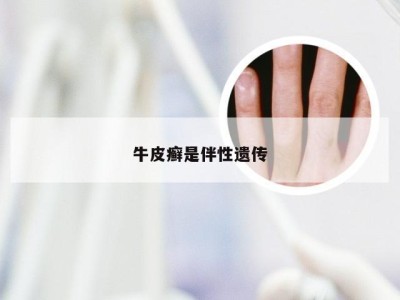 牛皮癣是伴性遗传
