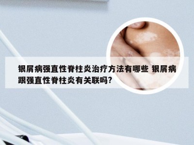 银屑病强直性脊柱炎治疗方法有哪些 银屑病跟强直性脊柱炎有关联吗?
