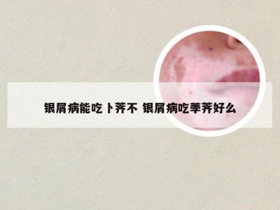 银屑病能吃卜荠不 银屑病吃荸荠好么