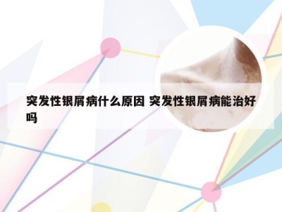 突发性银屑病什么原因 突发性银屑病能治好吗