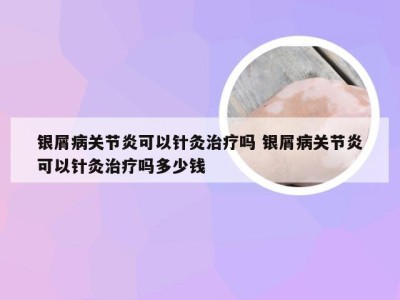银屑病关节炎可以针灸治疗吗 银屑病关节炎可以针灸治疗吗多少钱