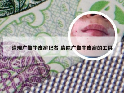清理广告牛皮癣记者 清除广告牛皮癣的工具