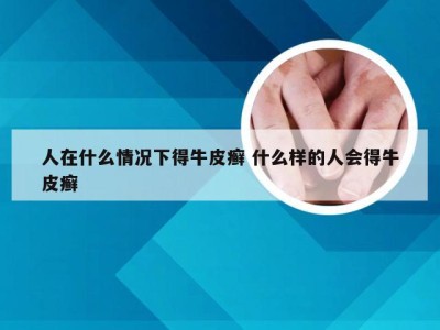 人在什么情况下得牛皮癣 什么样的人会得牛皮癣
