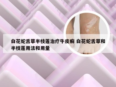 白花蛇舌草半枝莲治疗牛皮癣 白花蛇舌草和半枝莲用法和用量