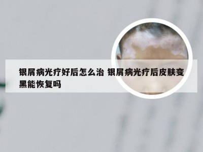银屑病光疗好后怎么治 银屑病光疗后皮肤变黑能恢复吗