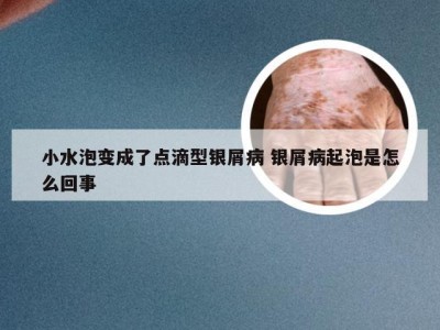 小水泡变成了点滴型银屑病 银屑病起泡是怎么回事