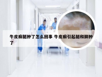 牛皮癣腿肿了怎么回事 牛皮癣引起腿和脚肿了