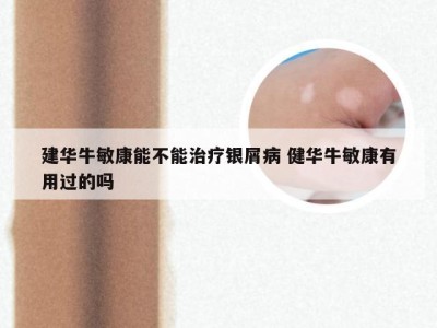 建华牛敏康能不能治疗银屑病 健华牛敏康有用过的吗