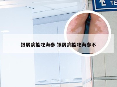 银屑病能吃海参 银屑病能吃海参不