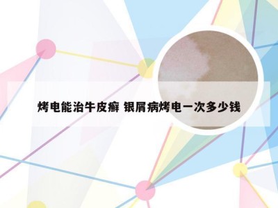 烤电能治牛皮癣 银屑病烤电一次多少钱