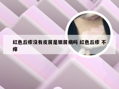 红色丘疹没有皮屑是银屑病吗 红色丘疹 不痒