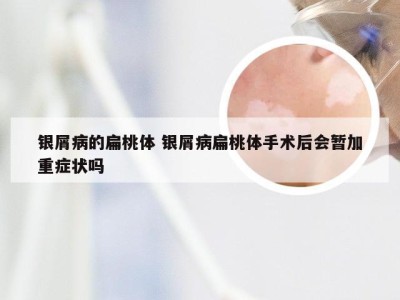 银屑病的扁桃体 银屑病扁桃体手术后会暂加重症状吗