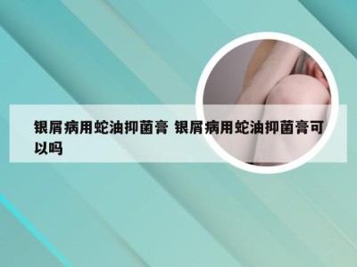 银屑病用蛇油抑菌膏 银屑病用蛇油抑菌膏可以吗
