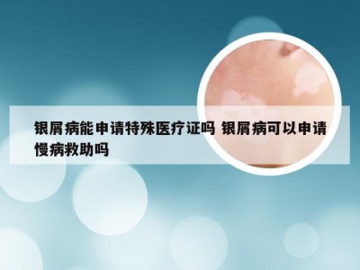 银屑病能申请特殊医疗证吗 银屑病可以申请慢病救助吗
