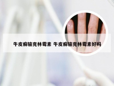 牛皮癣输克林霉素 牛皮癣输克林霉素好吗