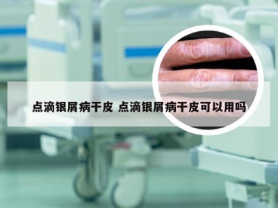 点滴银屑病干皮 点滴银屑病干皮可以用吗