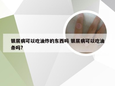 银屑病可以吃油炸的东西吗 银屑病可以吃油条吗?