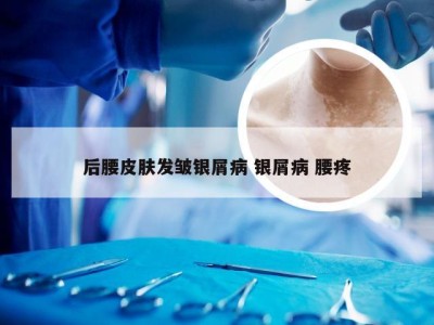 后腰皮肤发皱银屑病 银屑病 腰疼