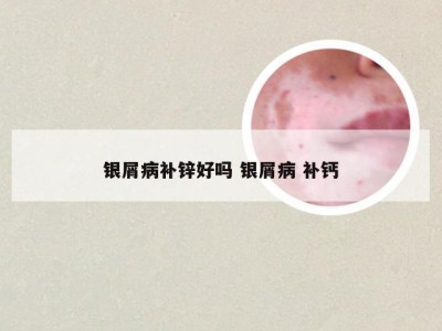 银屑病补锌好吗 银屑病 补钙