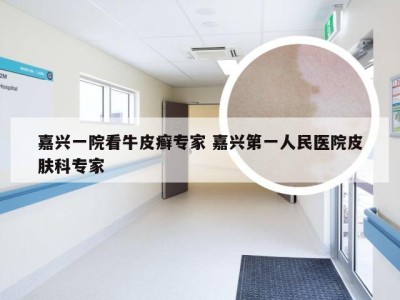嘉兴一院看牛皮癣专家 嘉兴第一人民医院皮肤科专家