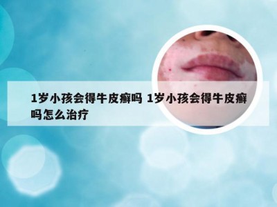 1岁小孩会得牛皮癣吗 1岁小孩会得牛皮癣吗怎么治疗