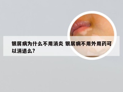 银屑病为什么不用消炎 银屑病不用外用药可以消退么?