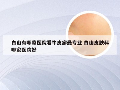 白山有哪家医院看牛皮癣最专业 白山皮肤科哪家医院好