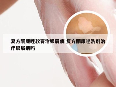 复方酮康唑软膏治银屑病 复方酮康唑洗剂治疗银屑病吗