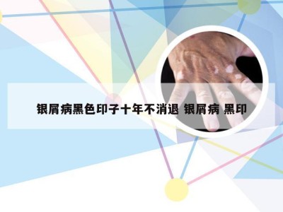 银屑病黑色印子十年不消退 银屑病 黑印