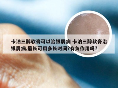 卡泊三醇软膏可以治银屑病 卡泊三醇软膏治银屑病,最长可用多长时间?有负作用吗?