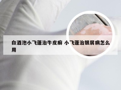 白酒泡小飞蓬治牛皮癣 小飞蓬治银屑病怎么用