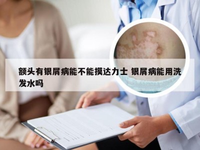 额头有银屑病能不能摸达力士 银屑病能用洗发水吗