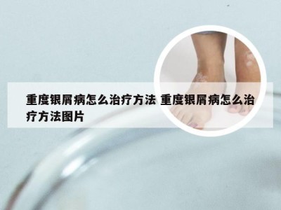 重度银屑病怎么治疗方法 重度银屑病怎么治疗方法图片