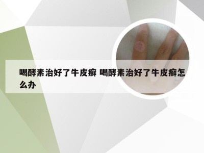喝酵素治好了牛皮癣 喝酵素治好了牛皮癣怎么办