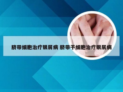 脐带细胞治疗银屑病 脐带干细胞治疗银屑病